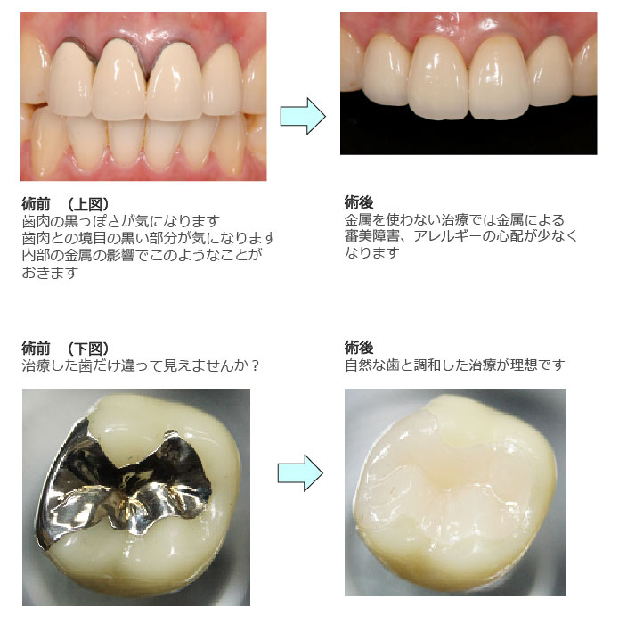 セラミックインレー・ジルコニア治療